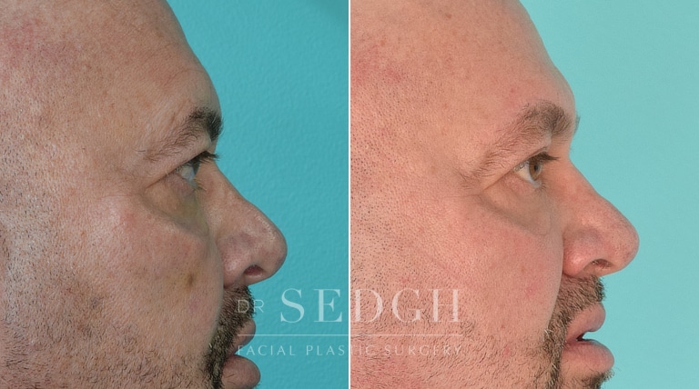 Male Patient Before and After Brow Lift | Sedgh