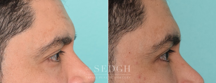 Male Patient Before and After Lower Blepharoplasty | Sedgh