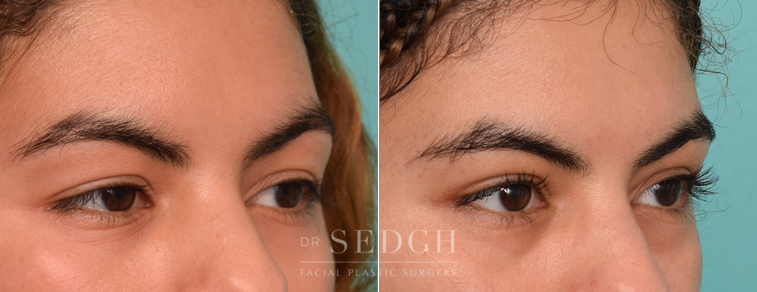 Female Patient Before and After Blepharoplasty | Sedgh
