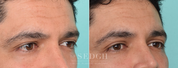 Male Patient Before and After Lower Blepharoplasty | Sedgh