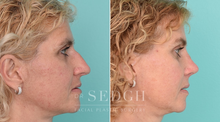 Female Patient Before and After Brow Lift | Sedgh