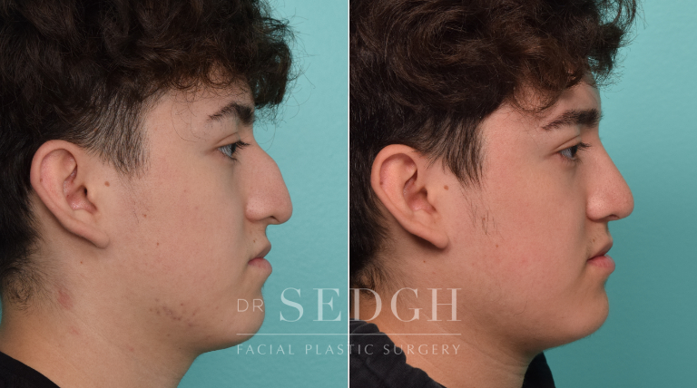 Male Patient Before and After Rhinoplasty | Sedgh