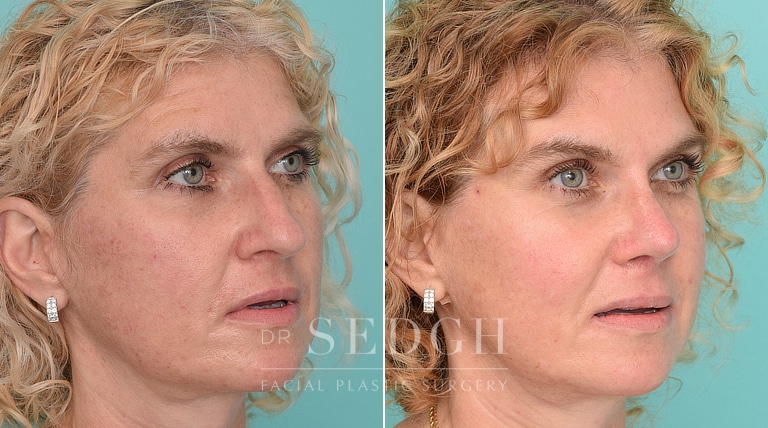 Female Patient Before and After Brow Lift | Sedgh