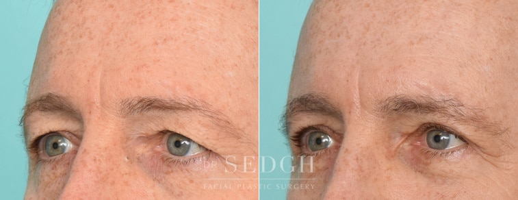 male patient before and after brow lift procedure