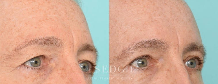 male patient before and after brow lift procedure