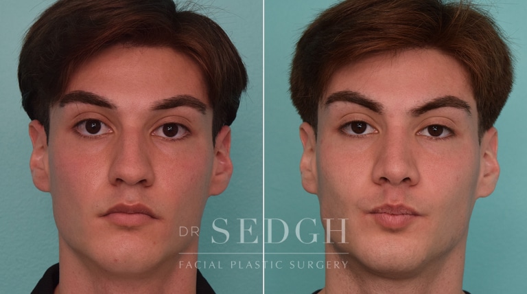 male patient before and after rhinoplasty procedure