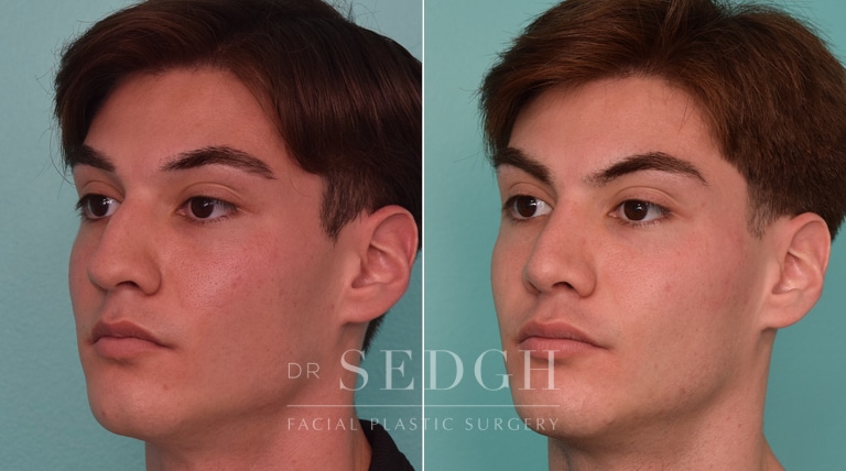 male patient before and after rhinoplasty procedure