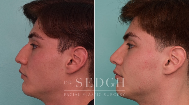 male patient before and after rhinoplasty procedure