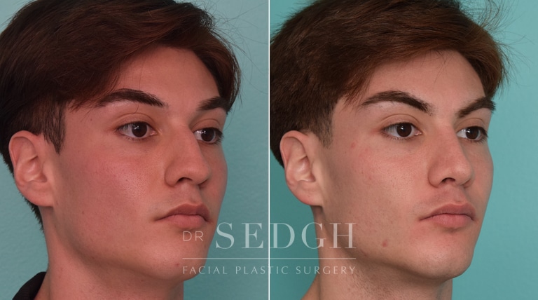 male patient before and after rhinoplasty procedure