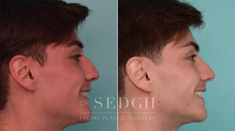 male patient before and after rhinoplasty procedure