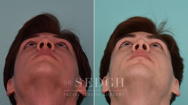 male patient before and after rhinoplasty procedure