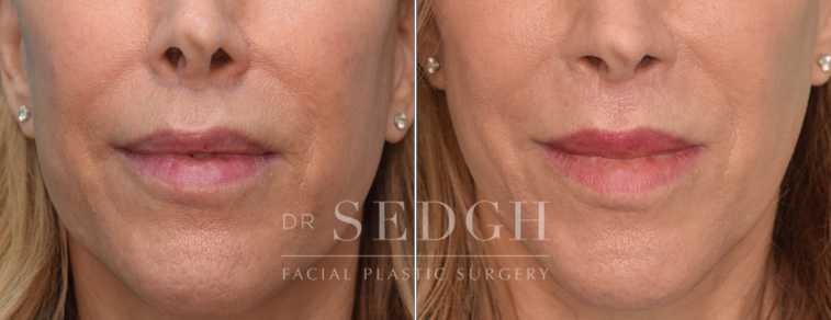 patient before and after lip lift procedure
