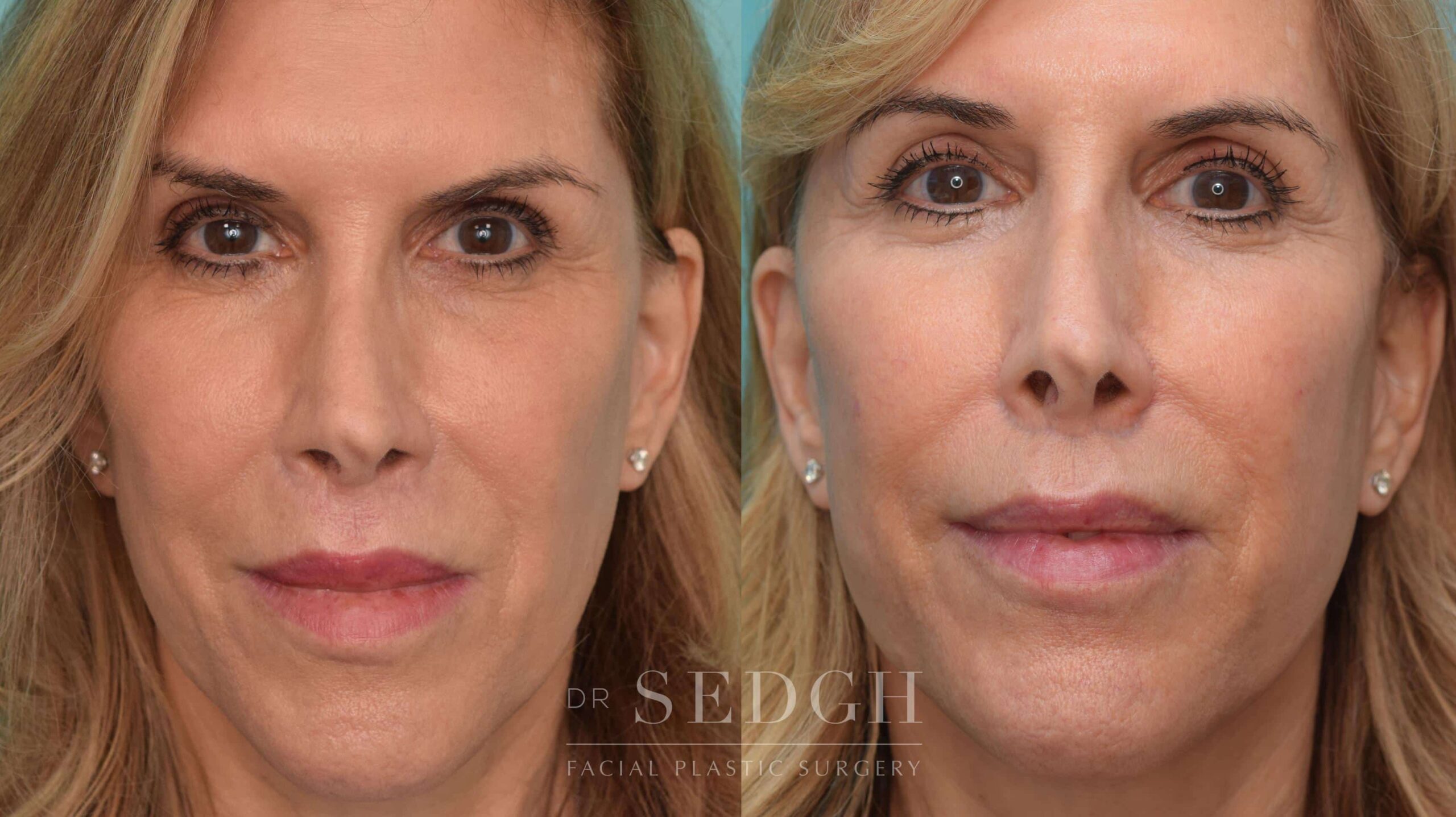 Lip Lift Before and After Photos | Dr. Sedgh
