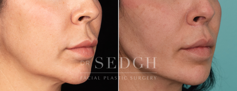 patient before and after lip lift procedure