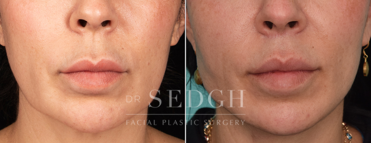 patient before and after lip lift procedure