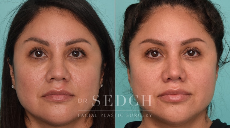 female patient before and after rhinoplasty procedure