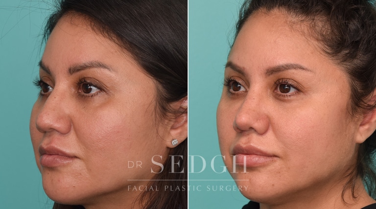 female patient before and after rhinoplasty procedure