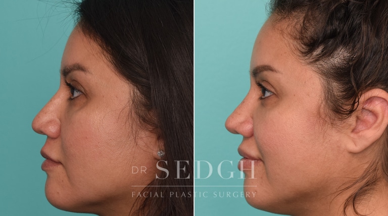 female patient before and after rhinoplasty procedure