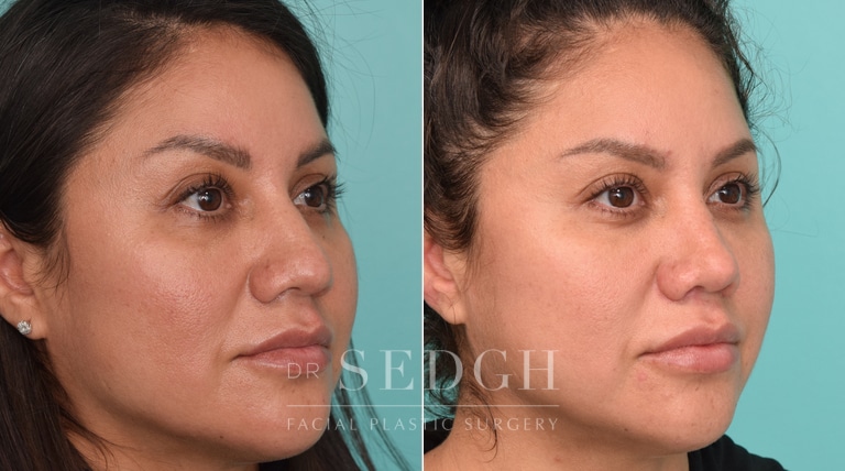 female patient before and after rhinoplasty procedure