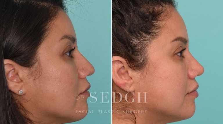 female patient before and after rhinoplasty procedure