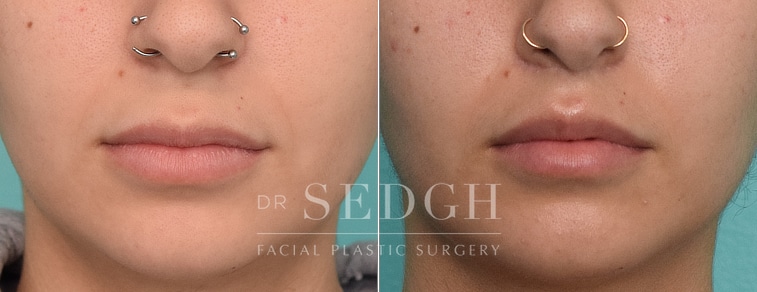 patient before and after lip lift procedure