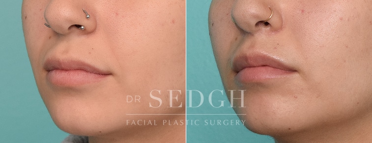 patient before and after lip lift procedure