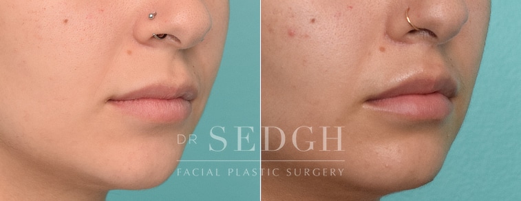 patient before and after lip lift procedure