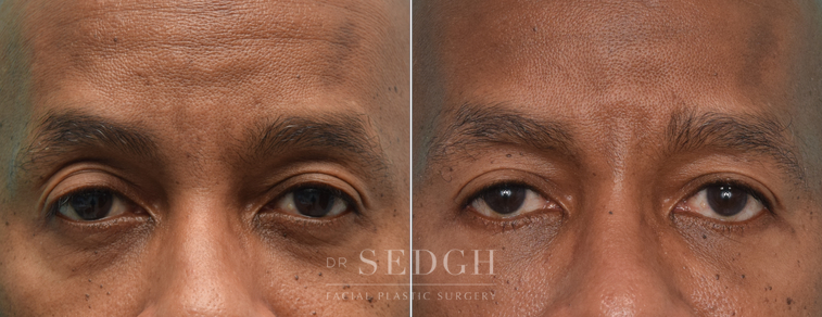 Lower Blepharoplasty Before and After | Sedgh