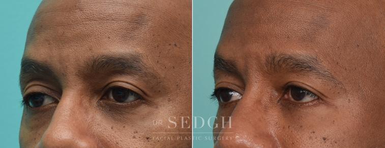 Lower Blepharoplasty Before and After | Sedgh