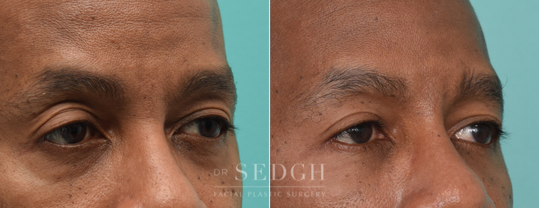 Lower Blepharoplasty Before and After | Sedgh