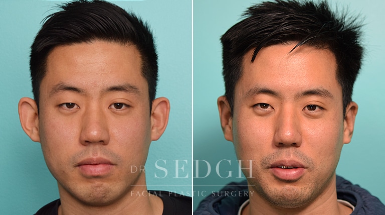 patient before and after otoplasty procedure