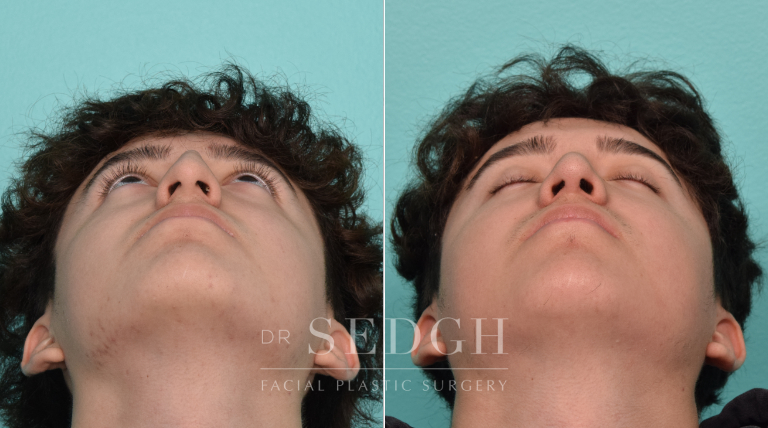 Male Patient Before and After Rhinoplasty | Sedgh