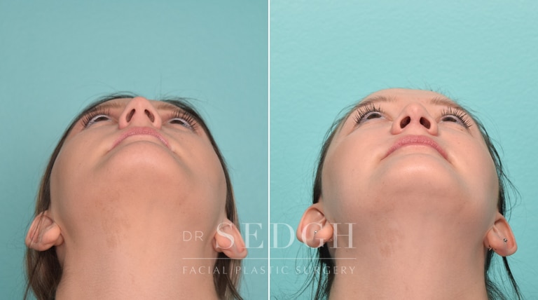 Female Patient Before and After Rhinoplasty | Sedgh