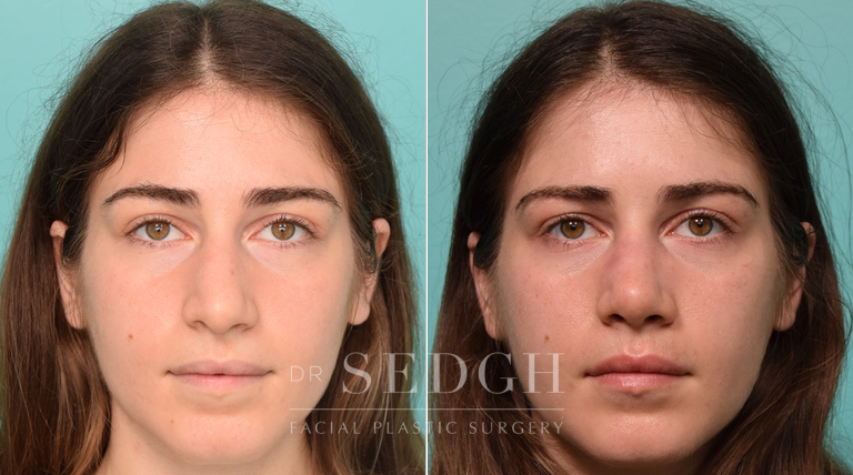 patient before and after revision rhinoplasty procedure