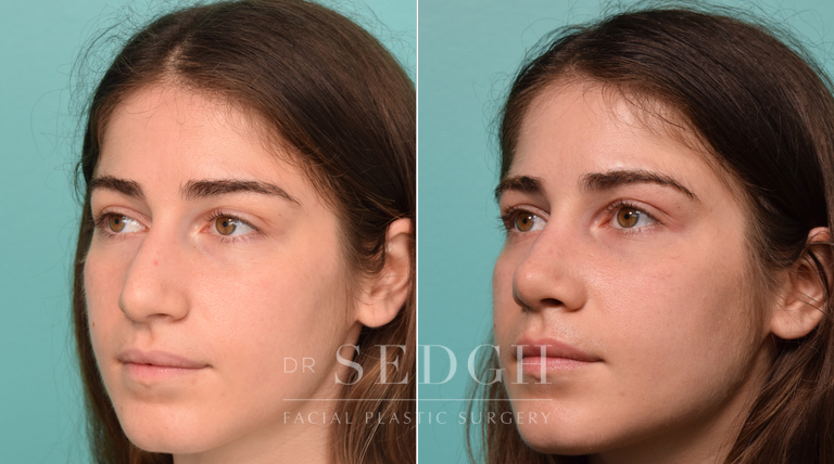 patient before and after revision rhinoplasty procedure