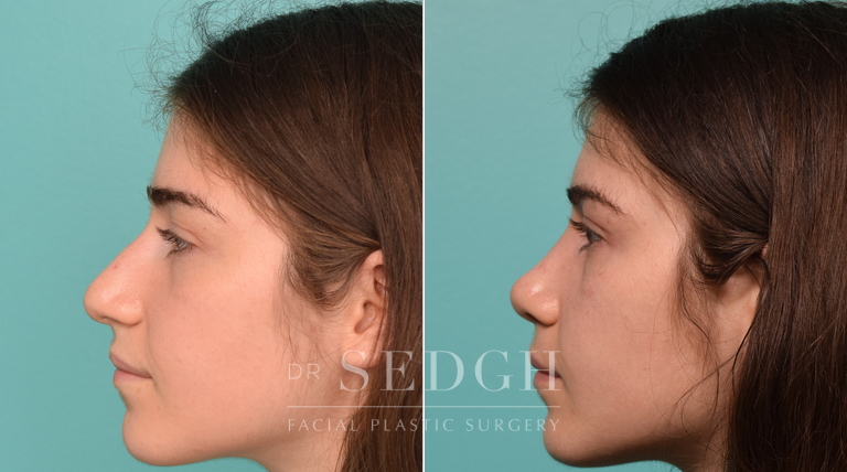 patient before and after revision rhinoplasty procedure