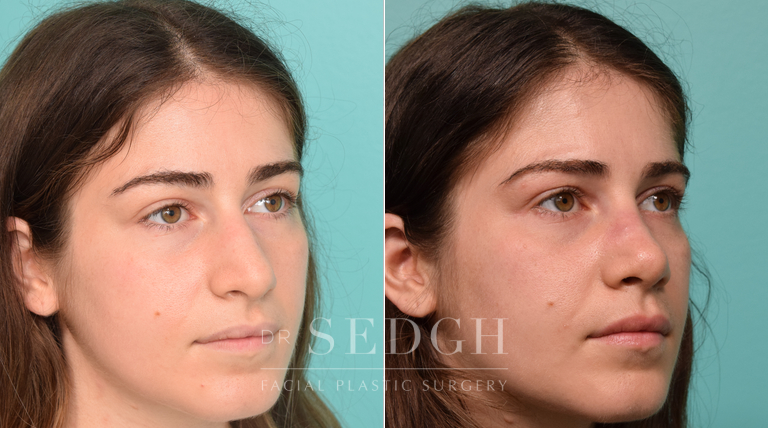 patient before and after revision rhinoplasty procedure