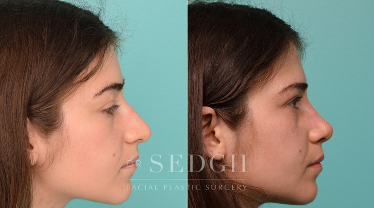 patient before and after revision rhinoplasty procedure