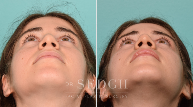 patient before and after revision rhinoplasty procedure