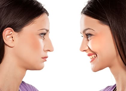 before and after Rhinoplasty surgery