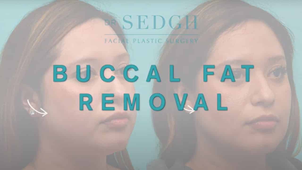 Buccal fat pad removal video
