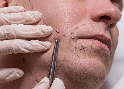 Man beauty procedure beard hair implant