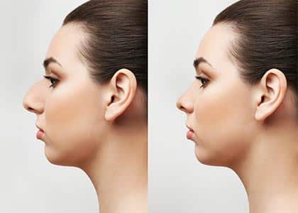 Young woman before and after rhinoplasty on light background