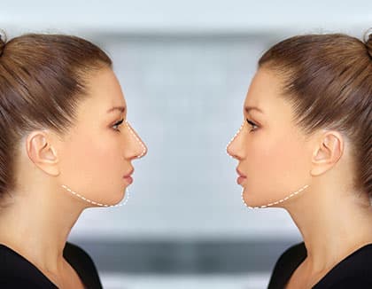 nose and chin correction, rhinoplasty, genioplasty and Chin augmentation