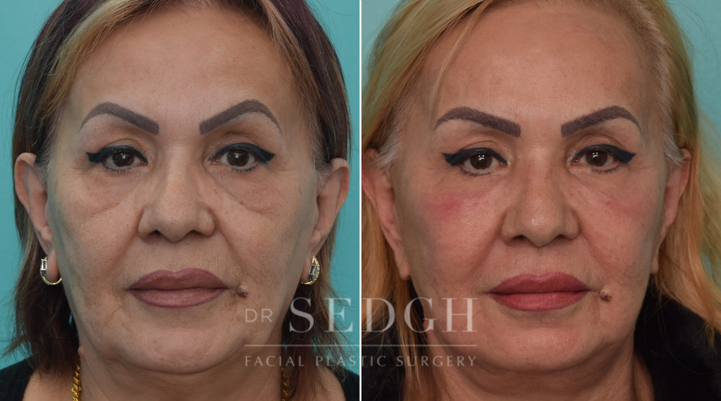 female patient before and after Facelift and Lower Blepharoplasty | Sedgh