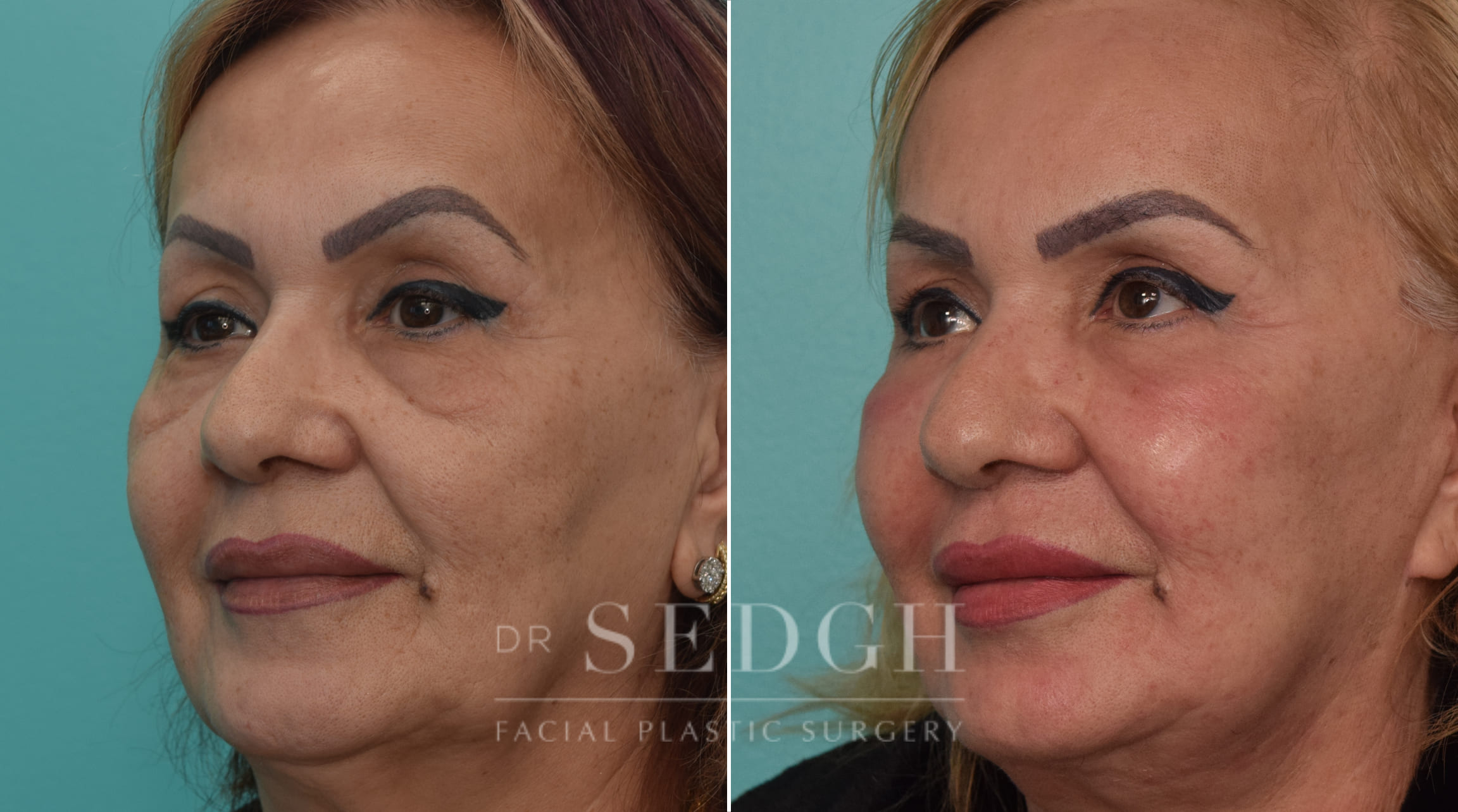 female patient before and after Facelift and Lower Blepharoplasty | Sedgh