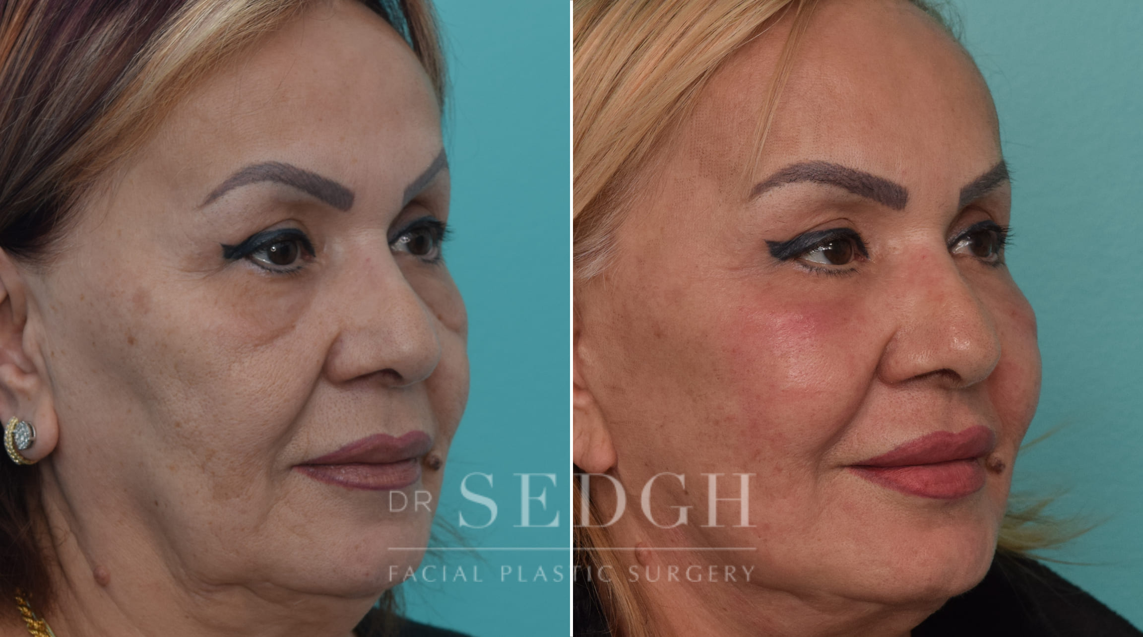 female patient before and after Facelift and Lower Blepharoplasty | Sedgh