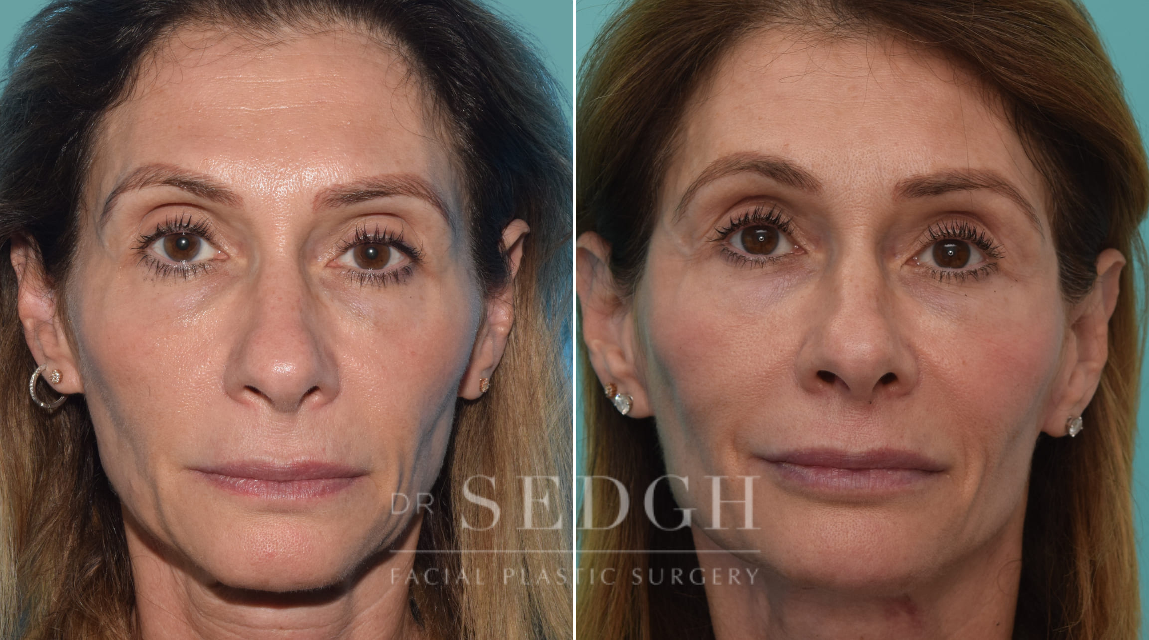 patient before and after face and neck procedure | Sedgh