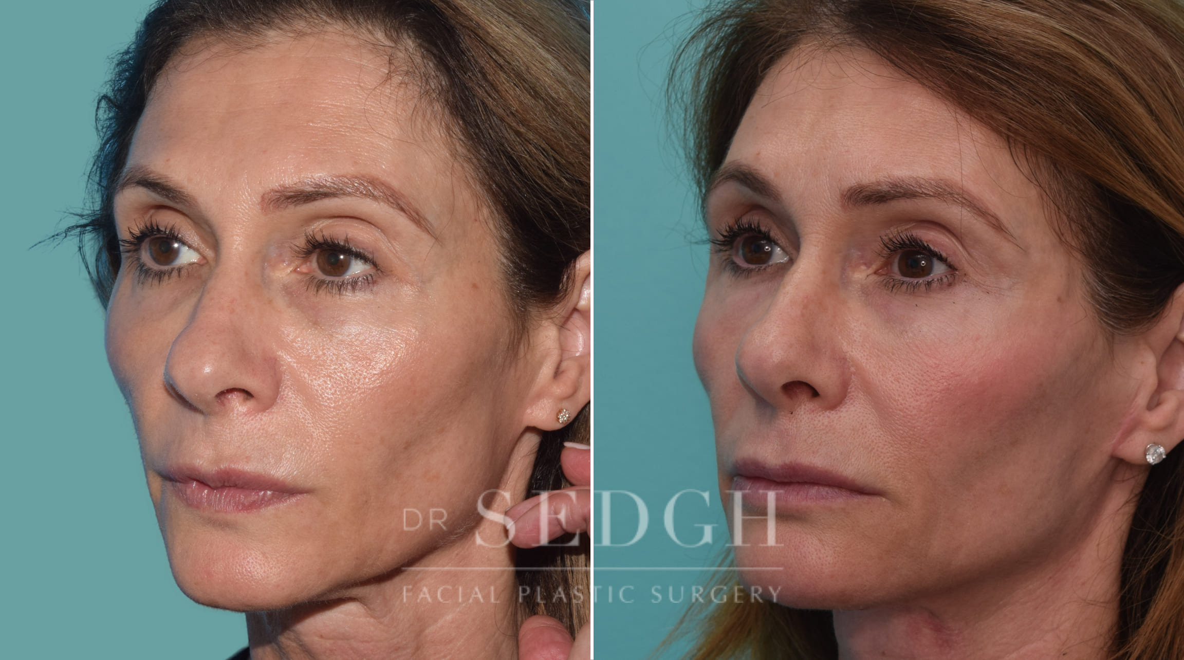 patient before and after face and neck procedure | Sedgh