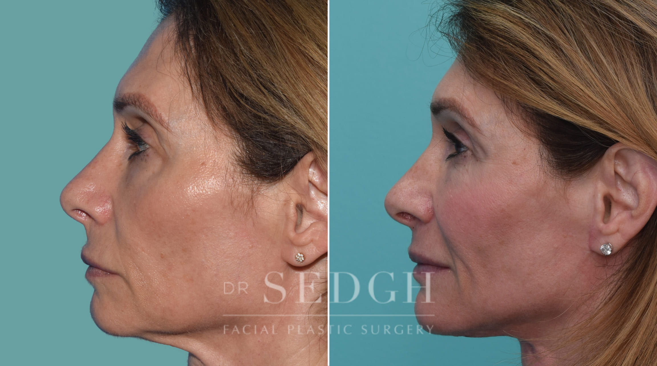 patient before and after face and neck procedure | Sedgh